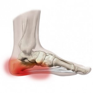 Heel Pain